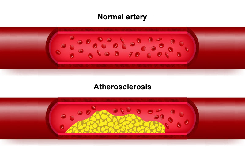 Atherosklerosis comparison